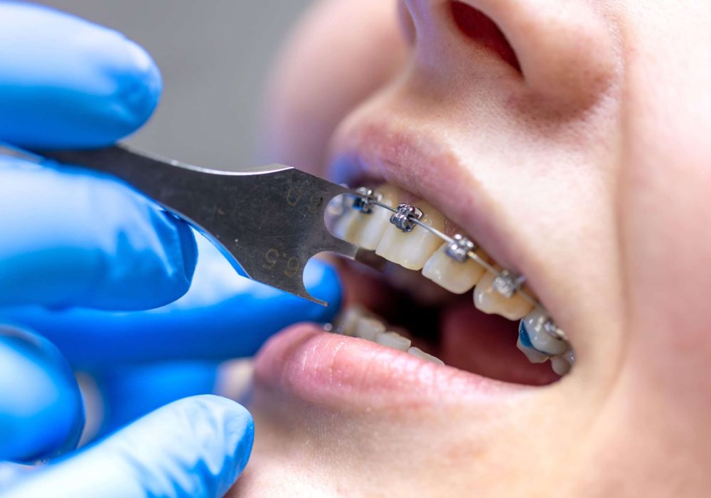procedimento-dentario-para-instalacao-de-aparelhos-dentarios-de-perto (1)