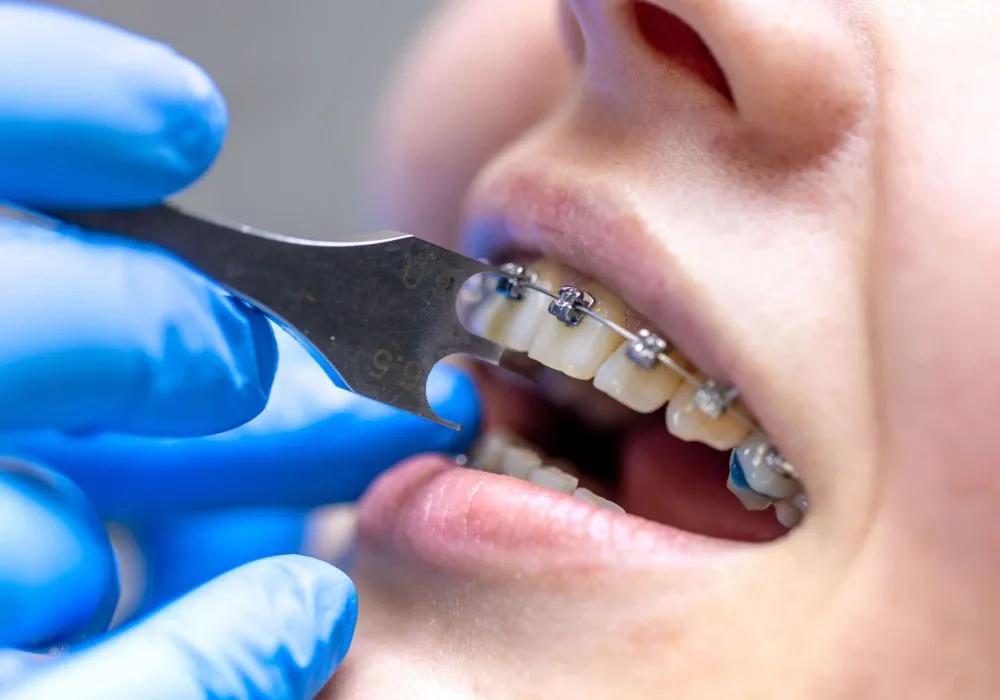 procedimento-dentario-para-instalacao-de-aparelhos-dentarios-de-perto (1)